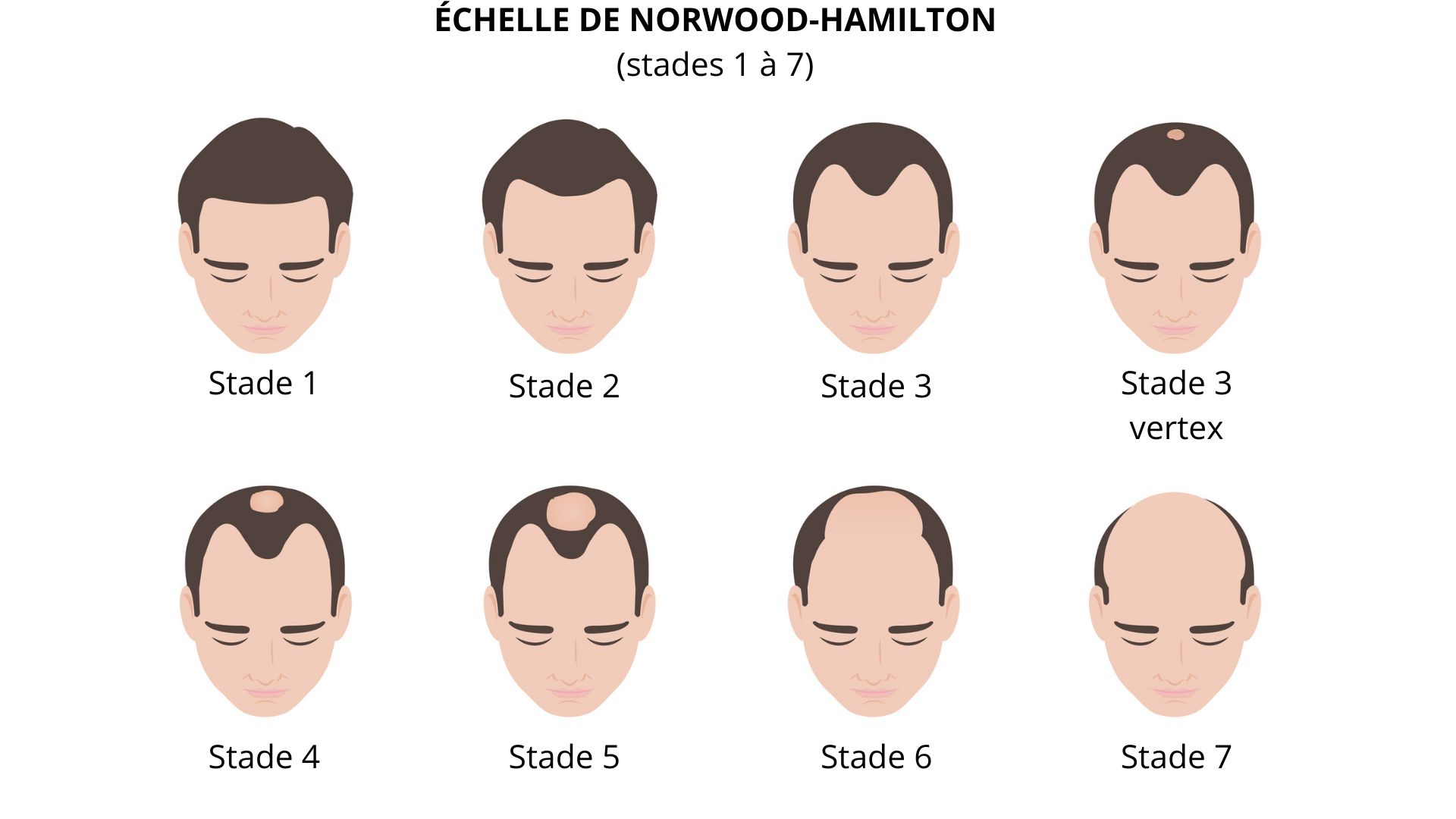 Échelle de Norwood-Hamilton